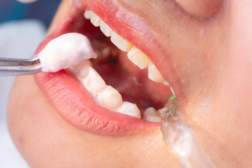 fluoride treatments for kids in cary