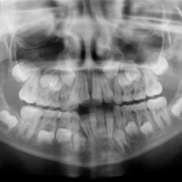 X-ray of teeth